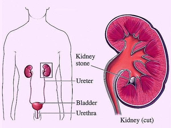 diagram of kidney pain